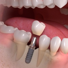 single-tooth-treatment-in-chennai